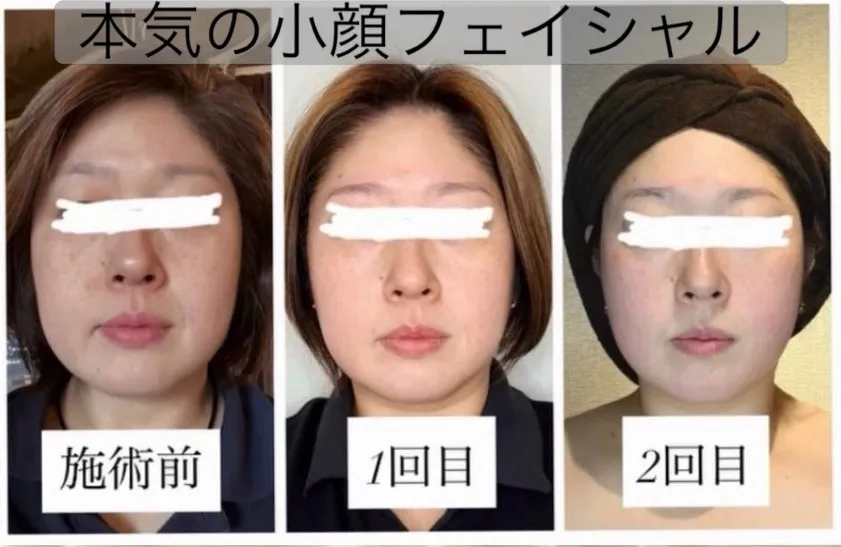 フェイシャル